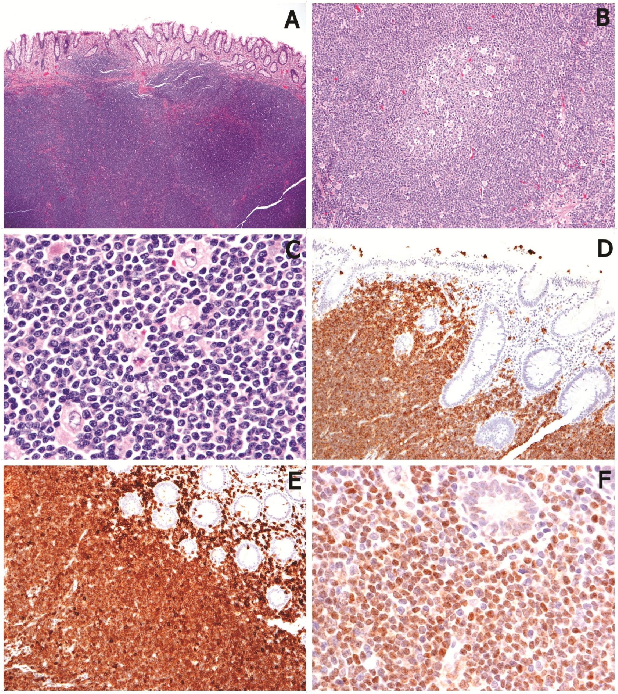 Mantle Cell Lymphoma Presenting As Multiple Lymphomatous Polyposis Of