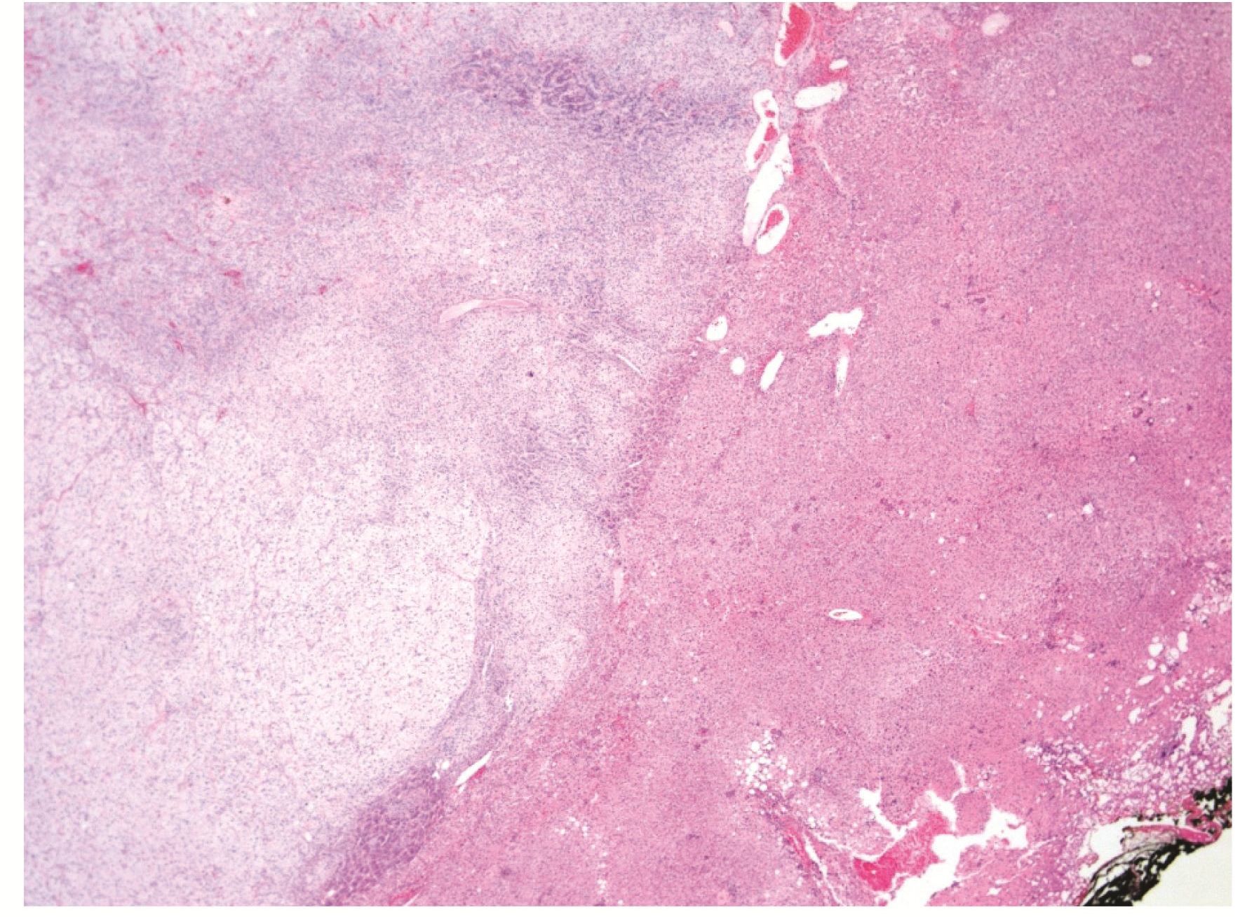 Non-functioning adrenal cortical adenoma arising in adrenohepatic